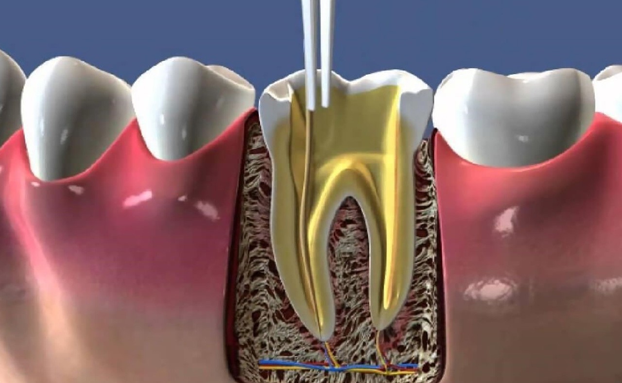 Endodonti (Kanal Tedavisi)</h4>